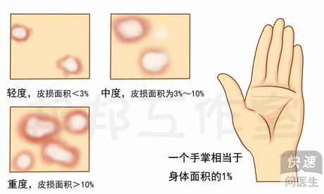 銀屑病怎樣治療？科學用藥是關鍵
