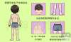 銀屑病怎樣治療？科學用藥是關鍵