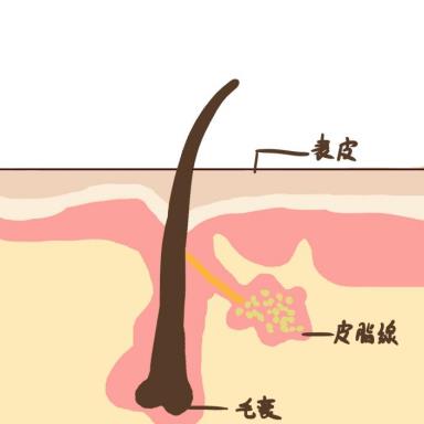 鼻頭毛孔粗大有黑頭如何改善？