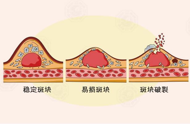 寒潮來襲時(shí)，別讓心腦血管病找上門