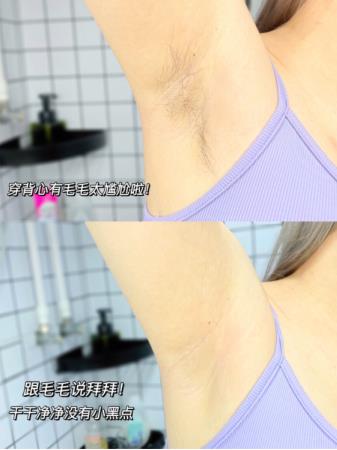 如何脫毛不留黑點？這種脫毛方式不能錯過