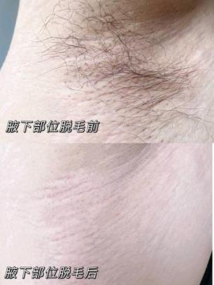 薇婷脫毛膏會使毛越來越粗嗎？真相是這樣的
