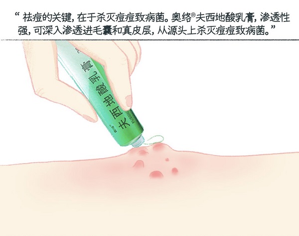 健康管理：玫瑰痤瘡用祛痘的產品管用不
