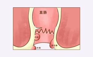 “痔”來敲門：什么藥治痔瘡效果好