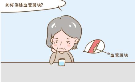“小”斑塊蘊含“大”危險，血管有斑塊怎么治療？