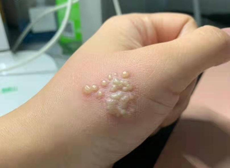 男子拍死隱翅蟲多處潰爛5天未愈?京萬(wàn)紅來(lái)支招了