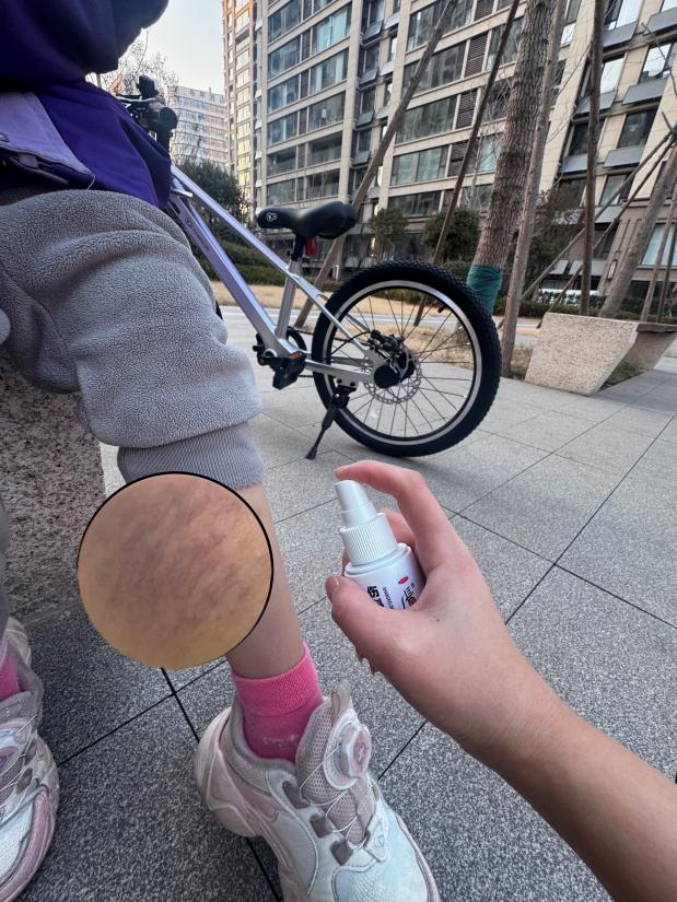 小腿拉傷腫脹一般要多久才會消？